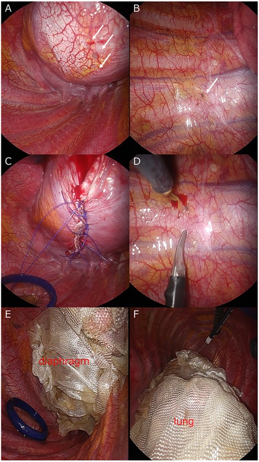 (A) Endometrial lesions of the diaphragm (arrow). (B) Endometrial lesions of the parietal pleura (arrow). (C) Diaphragm endometriosis is resected and hand sutures were added. (D) Lesions in the parietal pleura (arrow) are removed. (E) The entire surface of diaphragm and (F) the visceral pleura of lung is covered with ORC mesh.