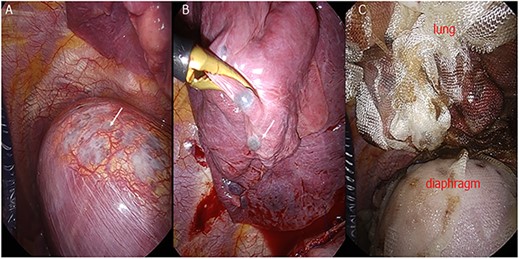 (A) Endometrial lesions of the diaphragm (arrow). (B) Endometrial lesions of the visceral pleura. (C) The entire diaphragm and lung are covered with ORC mesh.