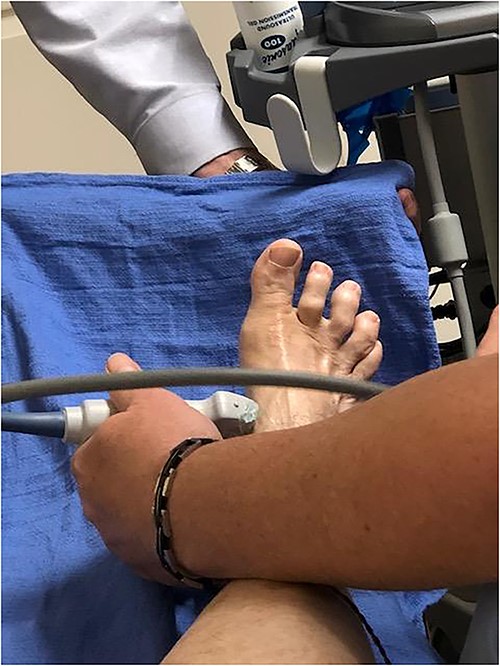 EMG Verification. EMG was used to determine the correct location of the abductor hallux brevis.