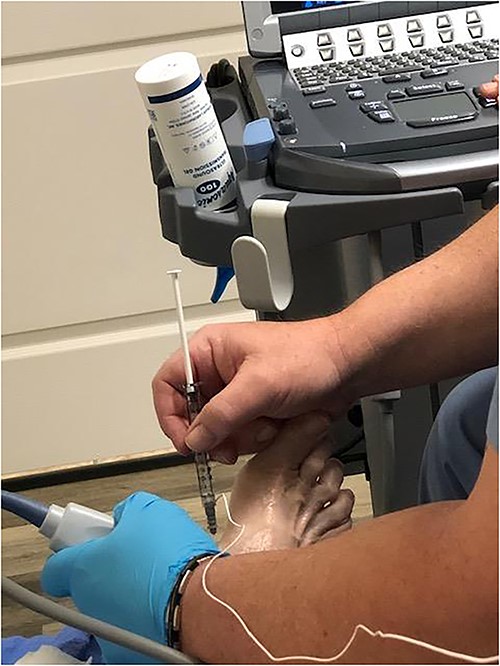 Ultrasound guided botulinum toxin injection. 30-gauge needle was used to inject the Botulinum toxin into the abductor hallucis brevis muscle belly.