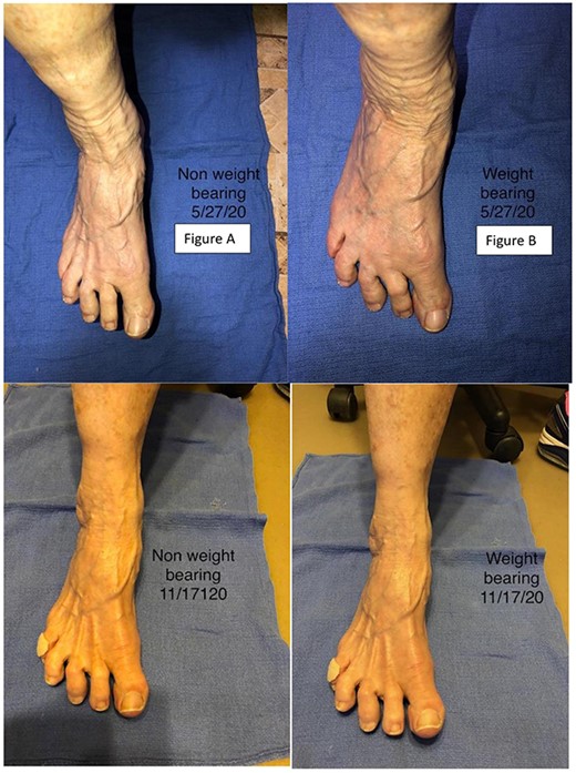 Patient progress images. Images in (A) and (B) shows the patient’s right foot none weight bearing and bearing weight, respectively, prior to the first injection. (C) and (D) show the patient at follow-up 2 months after the second injection non-weight bearing and weight bearing, respectively.