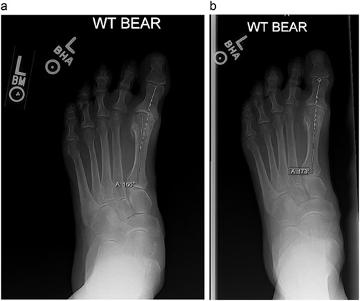 (a) and (b) are weight-bearing radiographs with angle measurements of the amount of hallux varus at the first MTP joint.