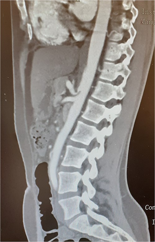 Compression of the celiac artery origin compatible with MALS; note the indentation on the superior wall of the celiac artery, leading to focal stenosis and absence of arterial wall thickening close to the stenosis.