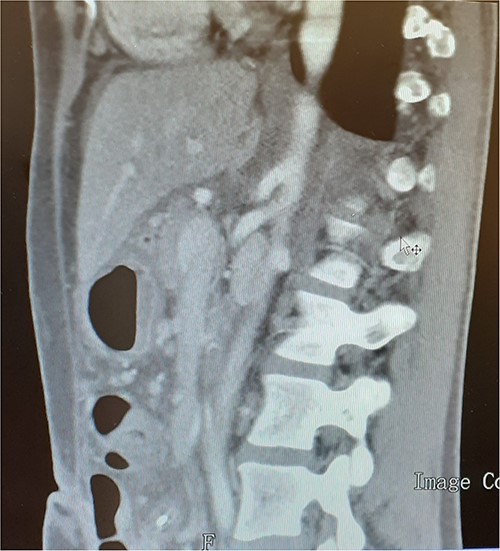 Imaging reassessment 1 month after surgical treatment.