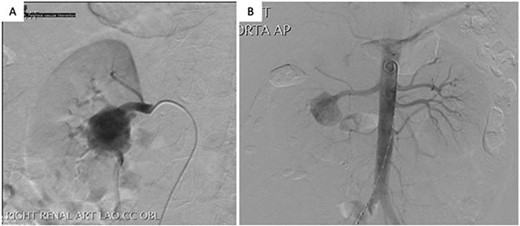 Arterial phase digital subtraction angiography: A) Selective run demonstrating a large RAA arising from the right renal artery bifurcation and involving segmental arteries. B) Aortogram demonstrating both renal arteries.