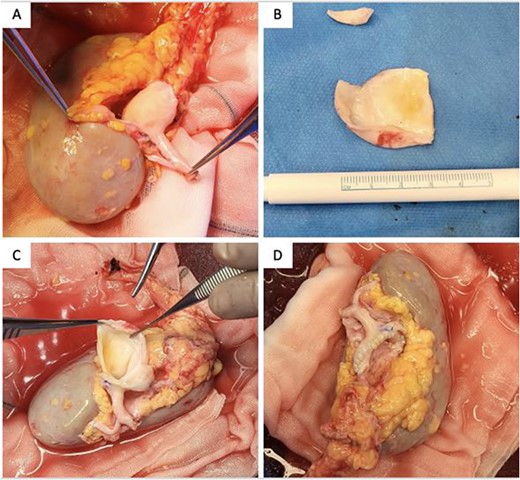 Intraoperative photographs of (A) specimen, (B) resected aneurysmal portion, (C) aneurysmectomy and (D) aneurysmorrhaphy/reconstructed renal artery.