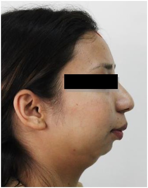 Preoperative clinical images: receding chin with hypoplastic mandible with bird face deformity.