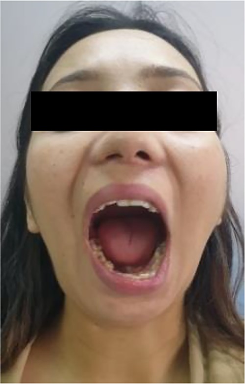 Twelve-month postoperative clinical images and maximum inter-incisal opening.