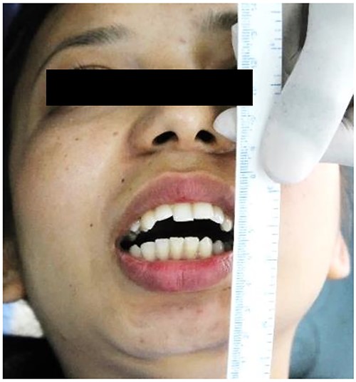 Preoperative clinical images: maximum inter-incisal opening.