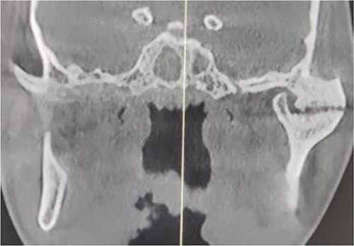 Preoperative computed tomography (coronal section): left-sided TMJA with radiographic suggestion of previous condylectomy at right-sided temporomandibular joint.