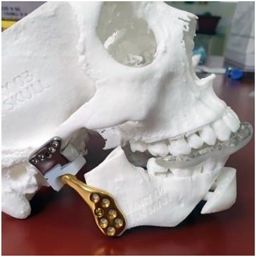 Total temporomandibular joint prosthesis with customized design and 3D printing.