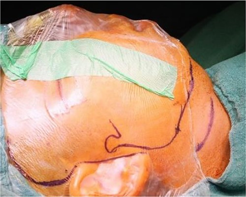 Intraoperative clinical images: marking for Al-Kayat and Bramley approach to the temporomandibular joint.