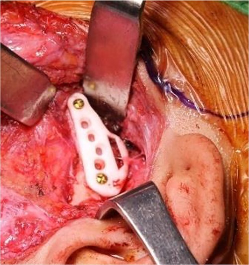 Intraoperative clinical images: placement of patient-specific cutting guides and osteotomy cut for condylectomy.