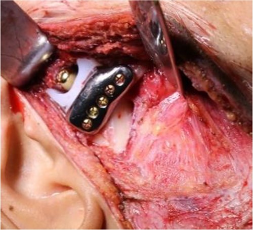 Intraoperative clinical images: positioning and final fixation of the custom prosthesis with screws.