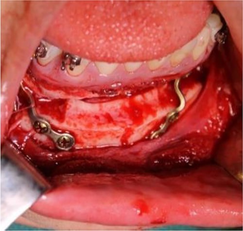 Intraoperative clinical images: horizontal advancement genioplasty and plate fixation.
