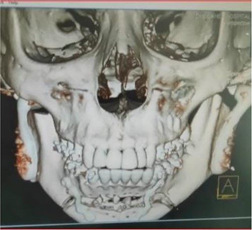 Postoperative 3D reconstruction of the temporomandibular joint prosthesis with horizontal advancement genioplasty.