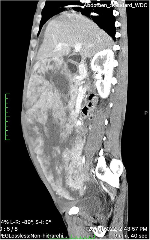 Contrast-enhanced CT scan showing a huge (30 × 26.5 × 15 cm) lobulated heterogeneously hyper-vascular mass lesion filling the whole abdominal cavity and extending down to the pelvis with internal cystic components.