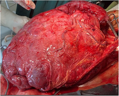 A large hyper-vascular abdominal tumor (32 × 30 × 15 cm) excised en-block with distal gastrectomy.