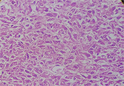 Histologic section of the tumor showing epithelioid cells with paranuclear clearance.