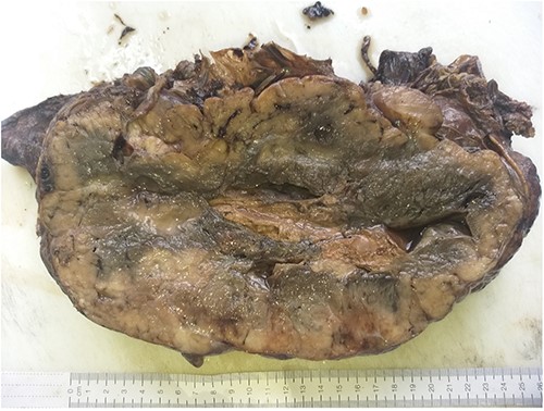 Gross tumor sectioned appearance with a well-circumscribed gray, white solid mass with areas of hemorrhage and cyst.