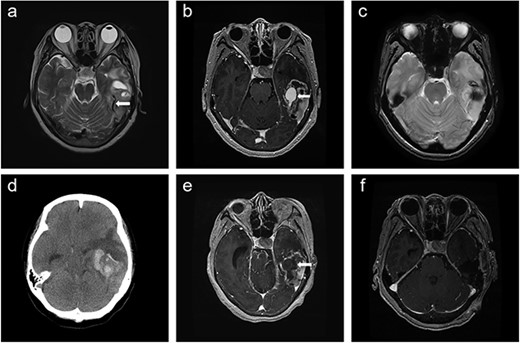 Time course of brain images during intratumoral hemorrhage formation; (a) initial T2-weighted image showing the tumor-draining vein without venous ectasia (arrow); (b, c) T1-enhanced image and gradient-echo image obtained 1 week after the initial MRI showing new-onset venous ectasia (arrow) without internal thrombus; (d, e) non-contrast-enhanced brain CT and T1-enhanced images obtained 1 day after images; (b) and (c) showing intratumoral hemorrhage with an intra-luminal thrombus (arrow); (f) post-operative T1-enhanced image.