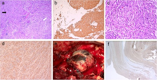 Pathologic images of the tumor and thrombosed venous ectasia; (a) the tumor had a biphasic appearance (white arrow: glial component, black arrow: sarcomatous component); the glial component had features of typical glioblastoma with nuclear pleomorphism and microvascular proliferation as well as positive immunoreactivity for glial fibrillary acidic protein (b); the sarcomatous area (c) contained spindle cells with moderate nuclear atypia and exhibited diffuse positivity for vimentin (d) protein; intraoperative view of thrombosed venous ectasia is presented in (e); histological analysis revealed that the vessel wall was negative for actin (f).