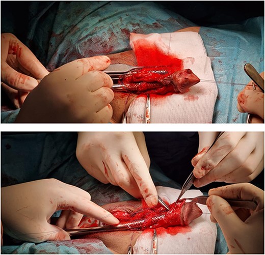Reconstruction of the ventral side of the middle and distal cavernosal bodies using Ultrapro Mesh.