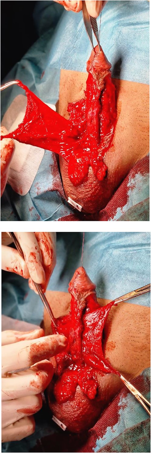 Mobilization of the urethra with a dartos flap from the right side was placed between the urethra and cavernosal bodies.