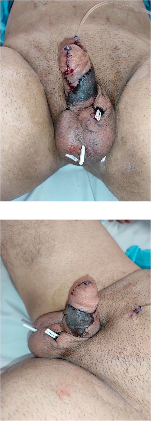 Three days after surgery: skin necrosis in the specific area of the flap.