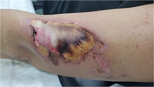 Wounds on the left arm when the patient presented to our clinic 2 weeks post pethidine Intravenous Injection.