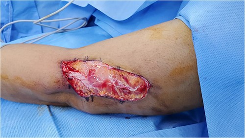 Wound post debridement.