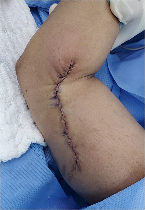 The wound post primary closur.