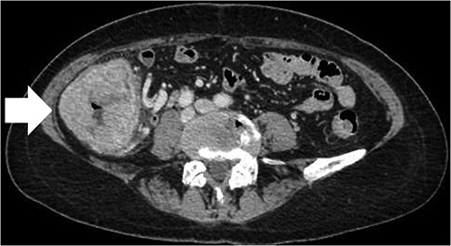 CT scan of the large tumor in the ascending colon (arrow).