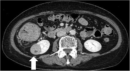 CT scan of the renal tumor in the lower pole of the right kidney (arrow).