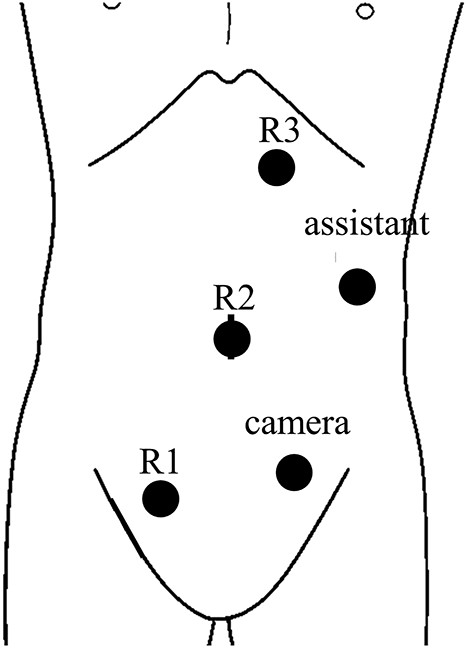 Trocar placement for robotic right hemicolectomy with the patient in the supine position.