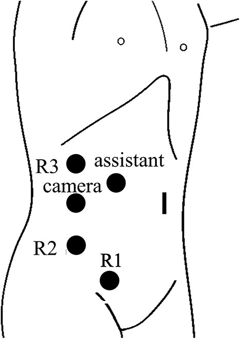 Trocar placement for robotic right partial nephrectomy with the patient in the left flank position. R1, located in right lower abdomen, was shared with the gastroenterologists.