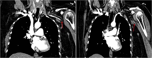 Occlusion of the axillary artery in the left upper limb.