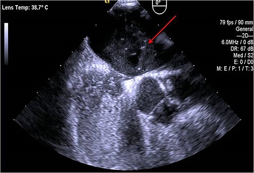 PFO identified in the bubble test.