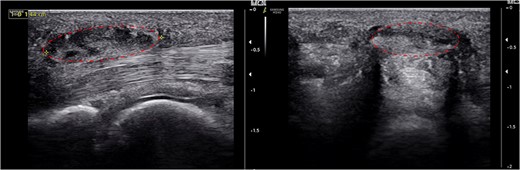 About 1.5 cm-sized hyperechoic mass (dotted circle) around the thickened A1 pulley and flexor tenosynovitis was detected.
