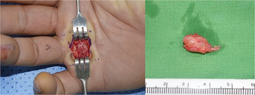 The encapsulated mass was excised through a longitudinal incision; the mass was surrounded with inflammatory tissue.