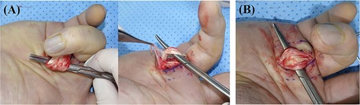 (A) Severe inflammatory tenosynovitis and adhesion around the flexor tendon was observed; (B) A longitudinally split flexor superficialis tendon lesion with tenosynovitis was observed.