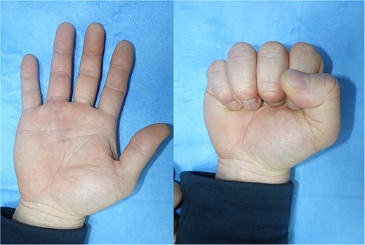 The appearance after 6 months post-operative showed a full range of motion without complications or symptoms.