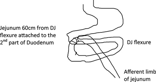 Diagram of duodenojejunostomy performed.