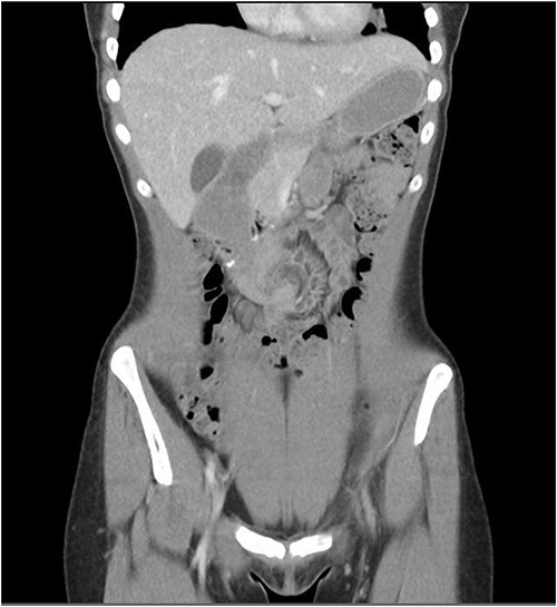 Admission CT showing ‘swirl’ pattern of volvulus.