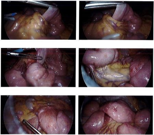 Internal hernia found on laparoscopy.