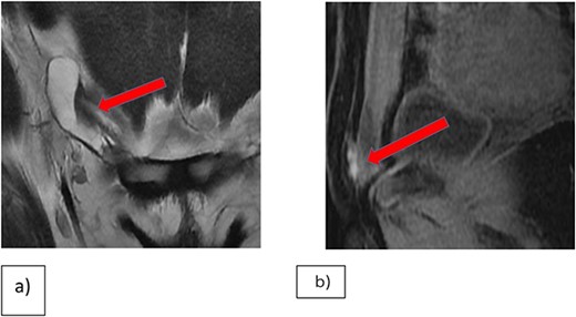 (a) Coronal T2WI showing right inguinal tubular cystic lesion that is communicating with peritoneum highly suggestive of communicating hydrocele of canal of Nuck. (b) MRI Sagittal T1 fat saturation, demonstrating that the medial superior aspect of the cyst is bright on T1WI in keeping with hemorrhagic contents versus endometrial implant.