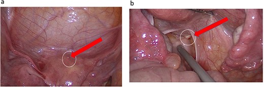 (a) Endometrial lesion in superoposteriar uterus. (b) Endometrial lesion in the base of right Fallopian tube.