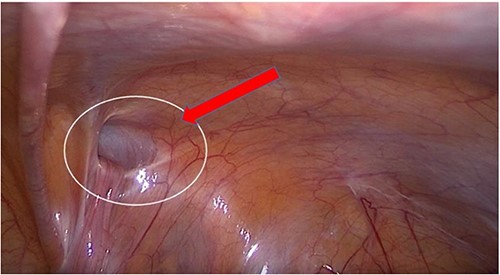 Transabdominal prepertoneal (TAPP) view of right inguinal defect.