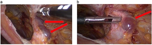 (a, b) Cyst over the right round ligament.