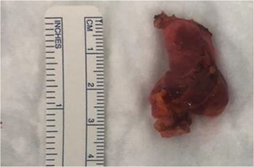 Right round ligament with the cystic lesion.